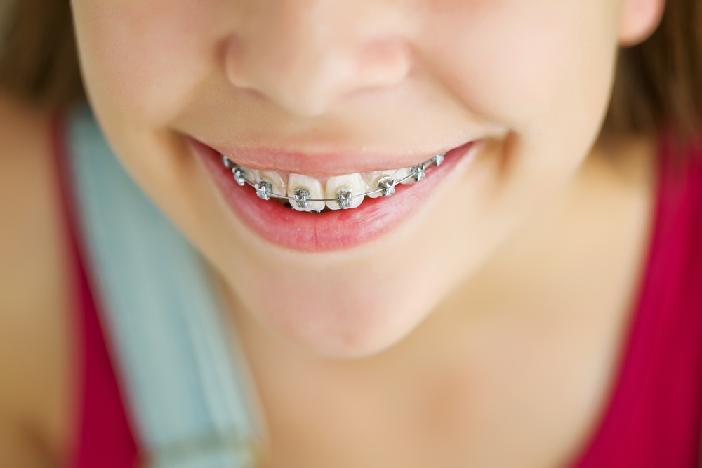 Orthodontic Treatment For Children